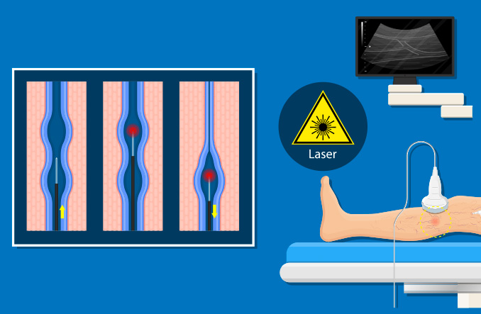 Laser endoveineux