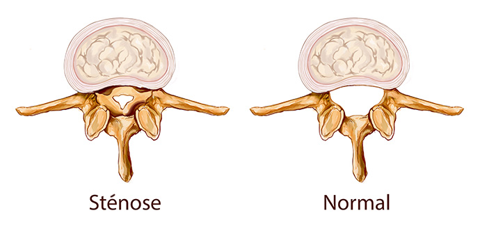 Sténose carotidienne